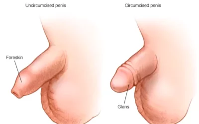 ما هو الختان للذكور؟