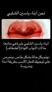 علاج الطنطاف