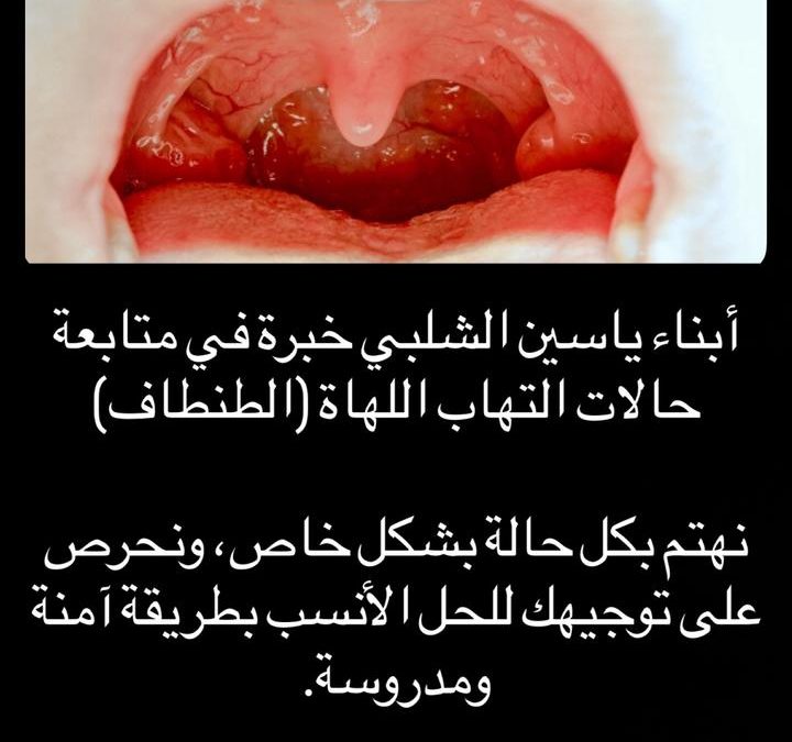 علاج الطنطاف